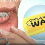 uso cera ortodontica